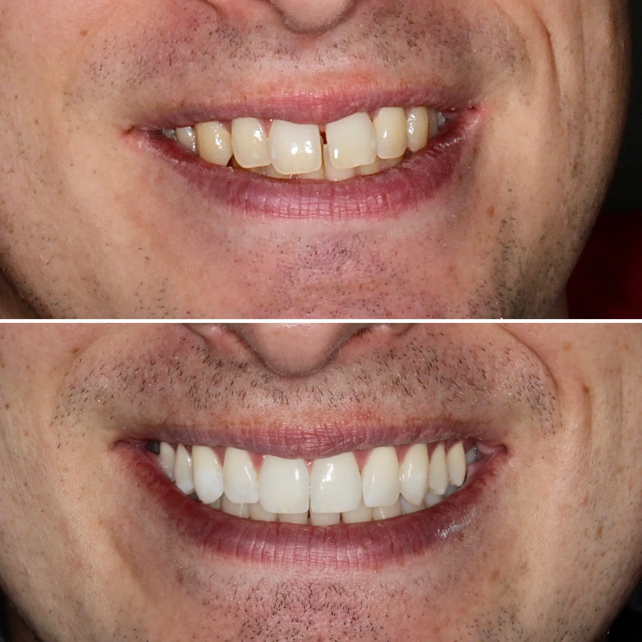 Smile-HQ-Invisalign-Essex-3