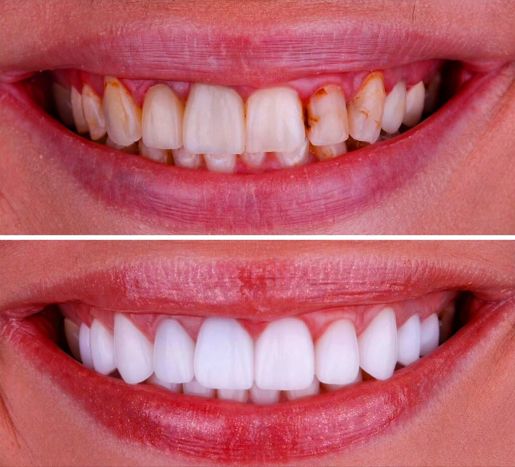 composite bonding
