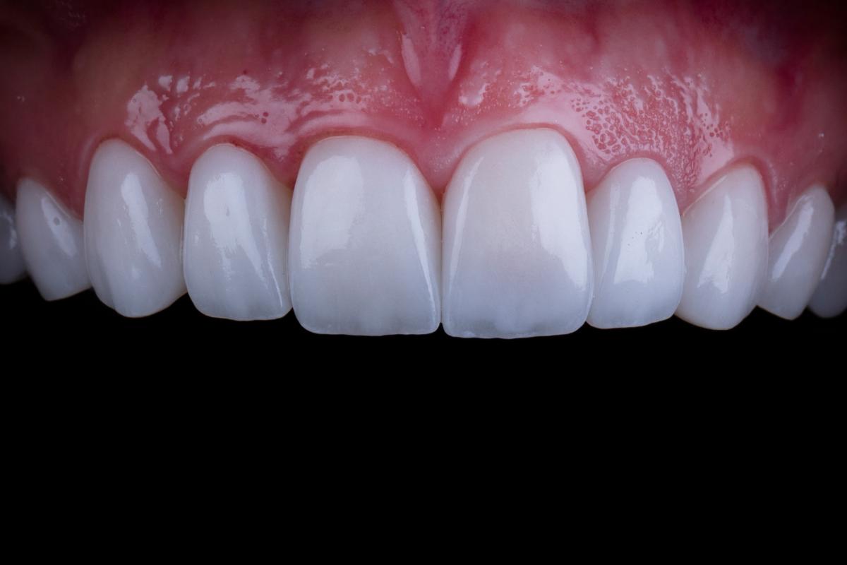 5-Benefits-of-Dental-Veneers