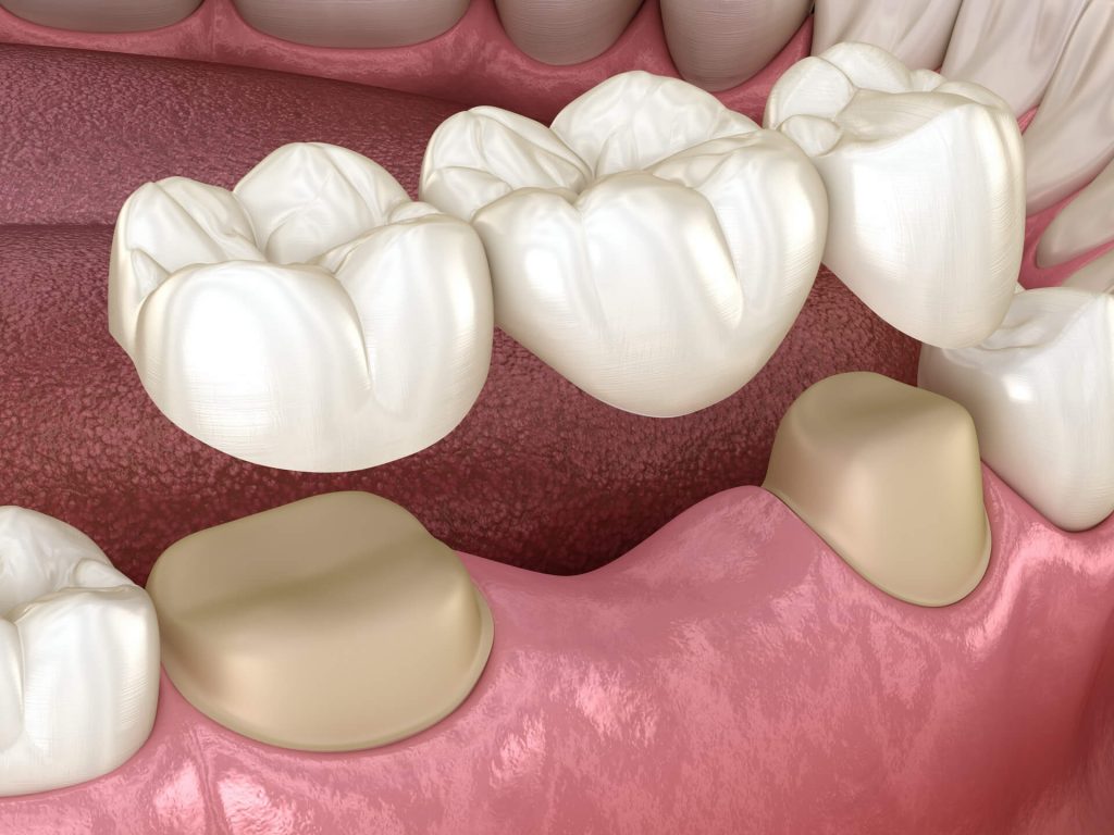 Dental-Bridges