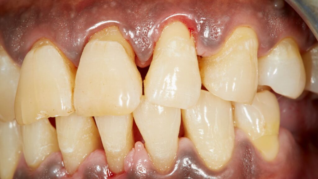 Periodontitis