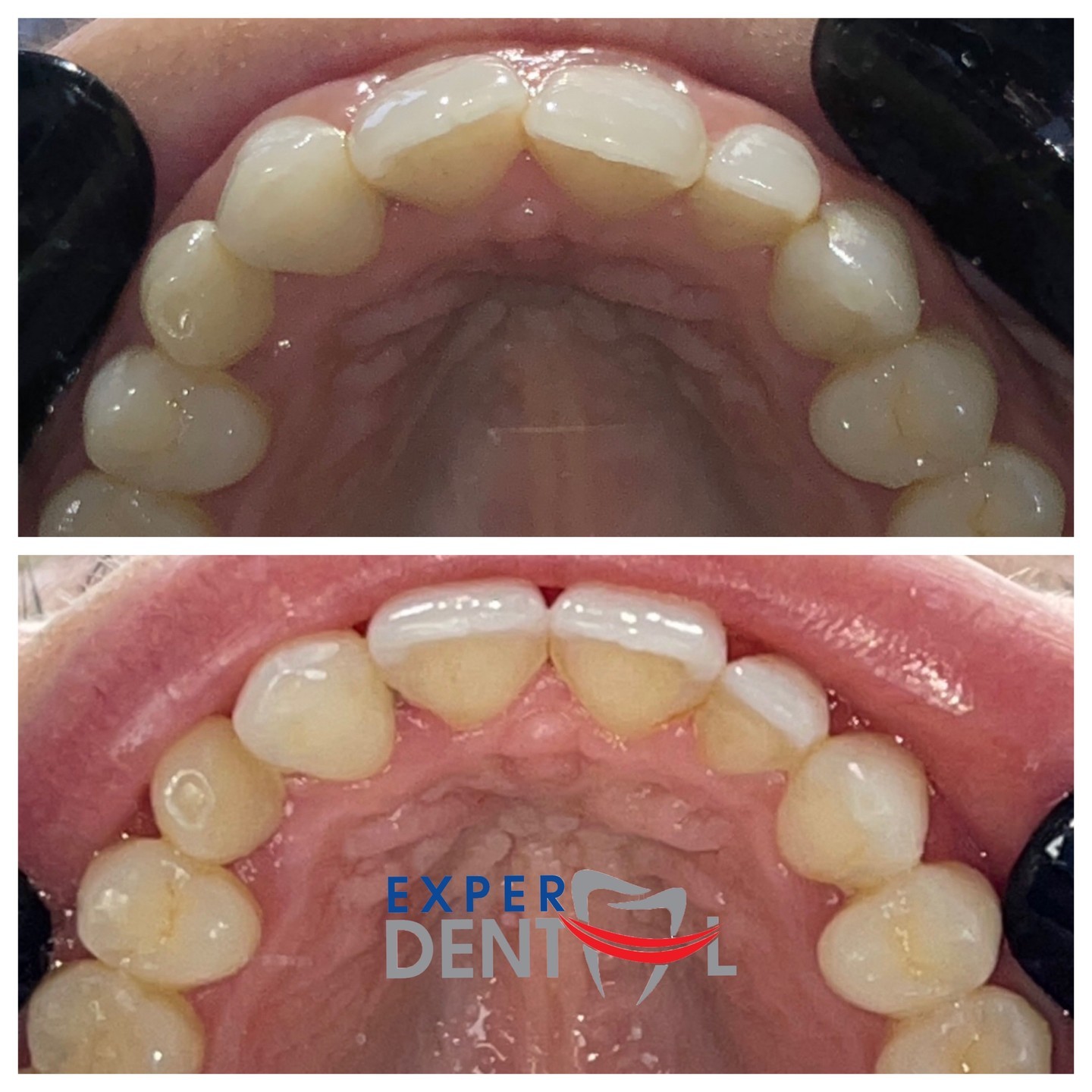 Teeth Straightening 3