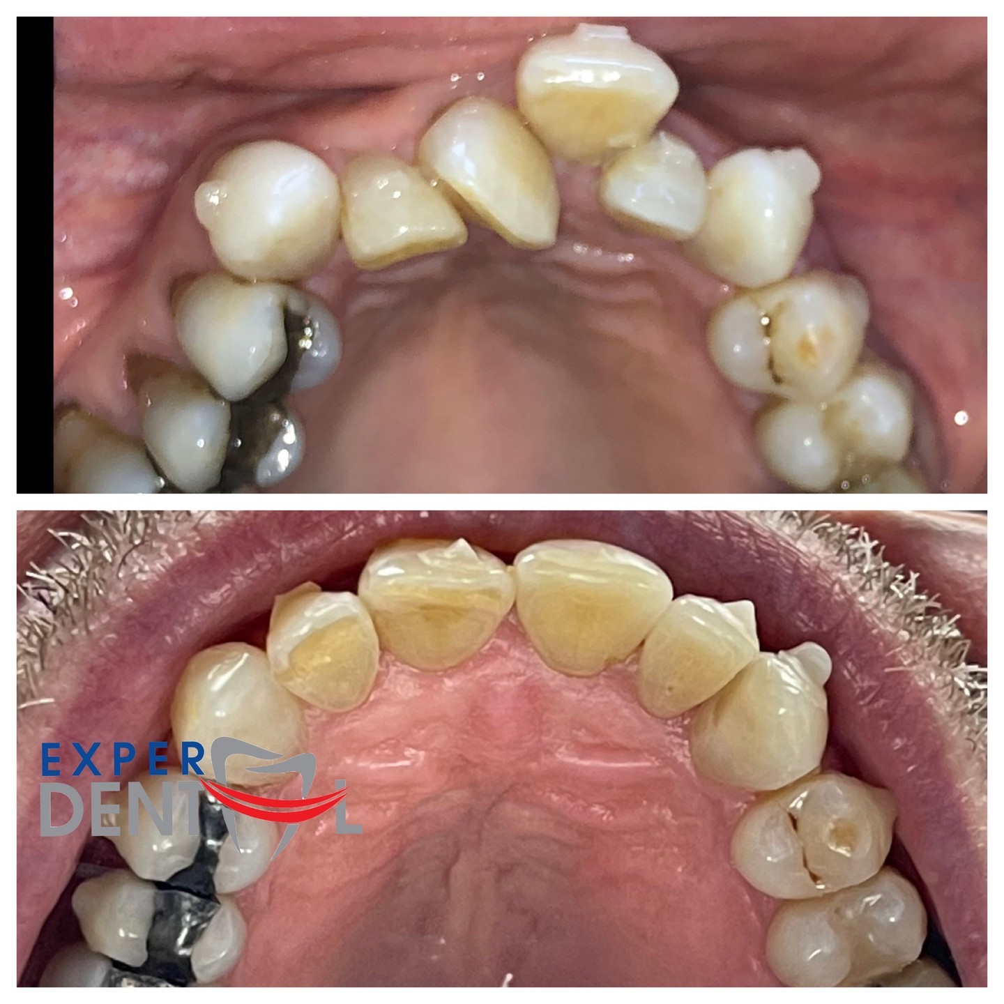 Teeth Straightening 5