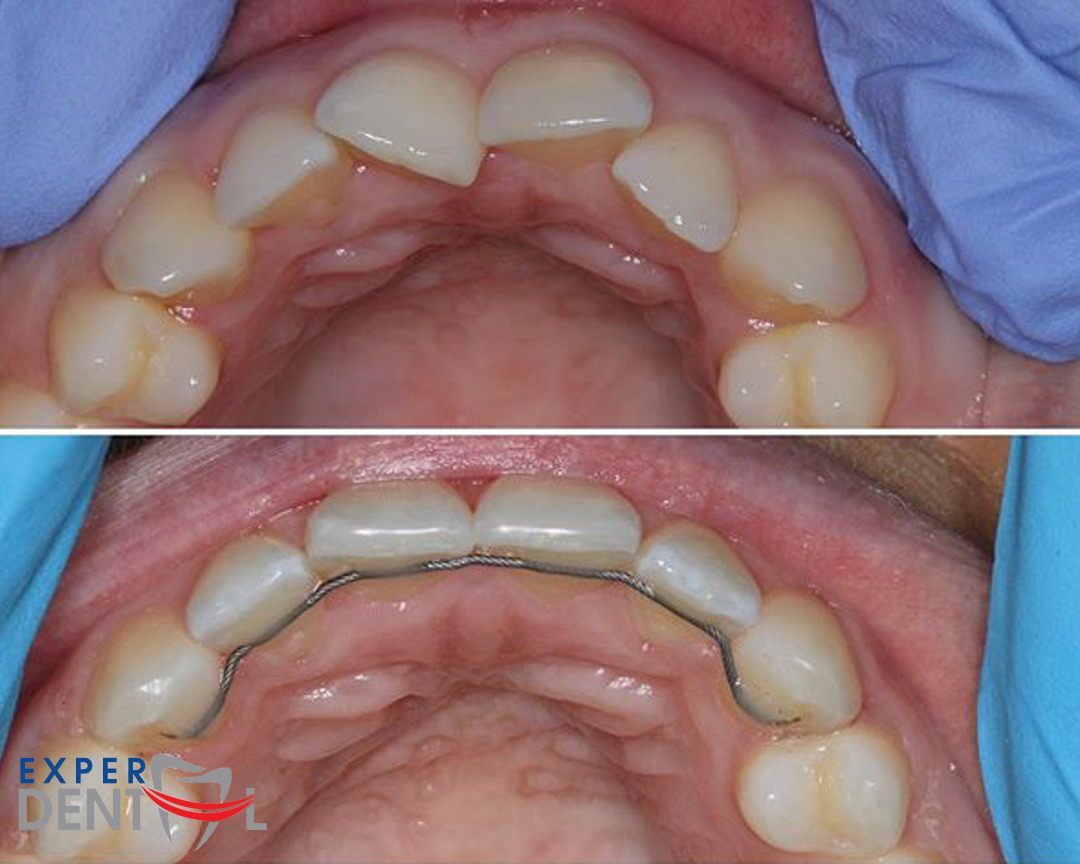 Teeth Straightening