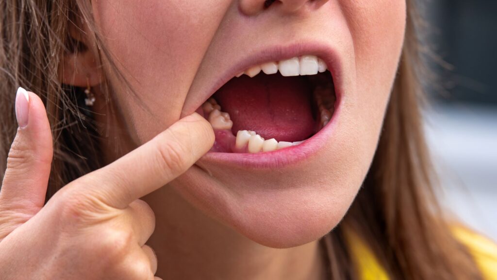 advanced-signs-of-gum-disease