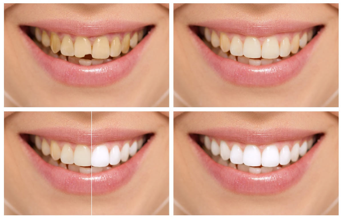 dental-bonding-westwood
