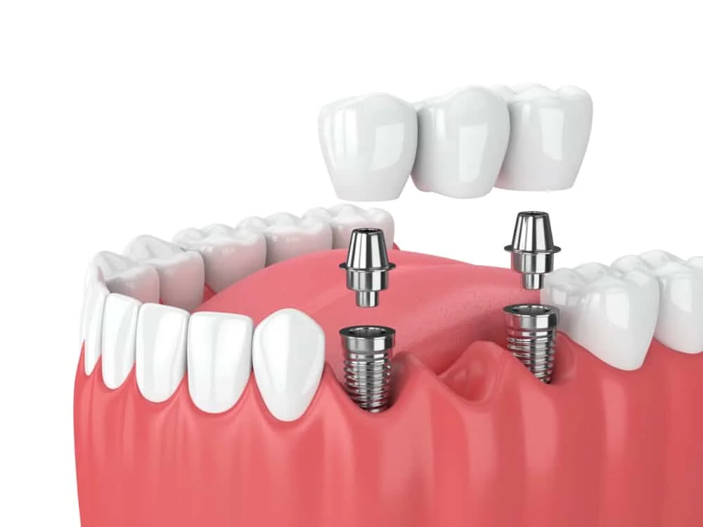 dental-implant-bridge