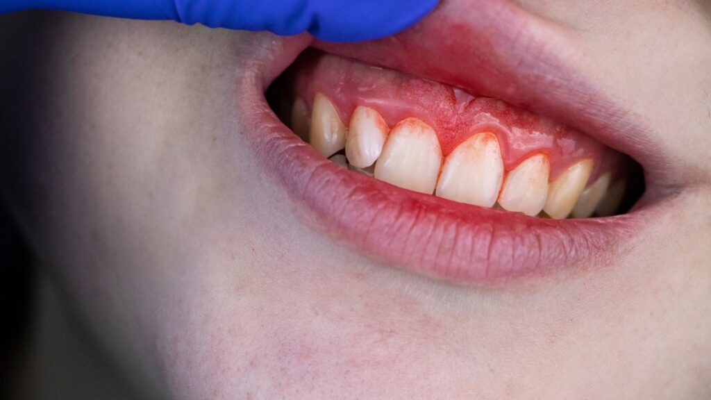 gingivitis