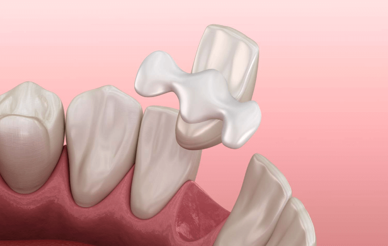 maryland-dental-bridge-768x487-1