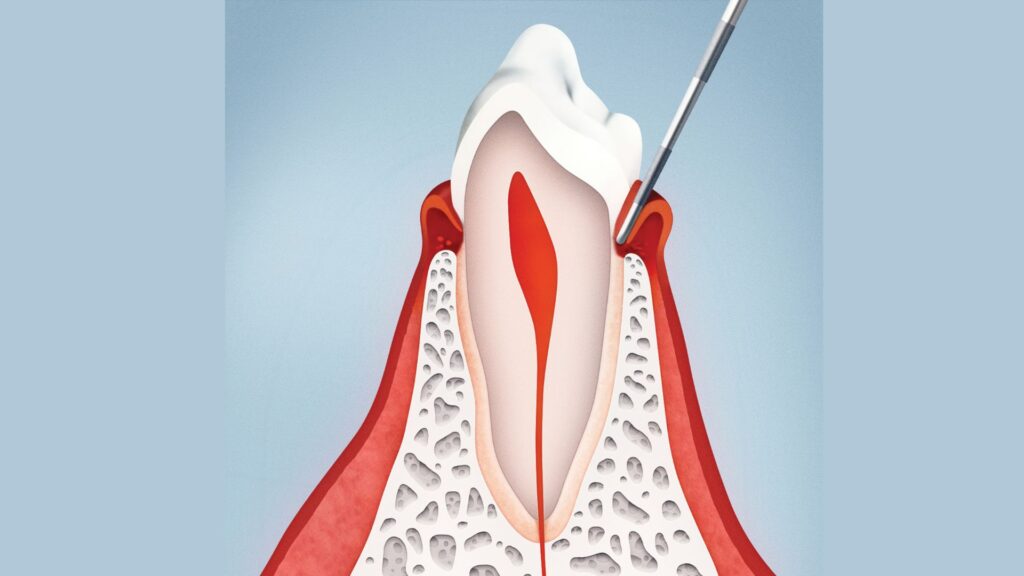 measuring-periodontal-pocket
