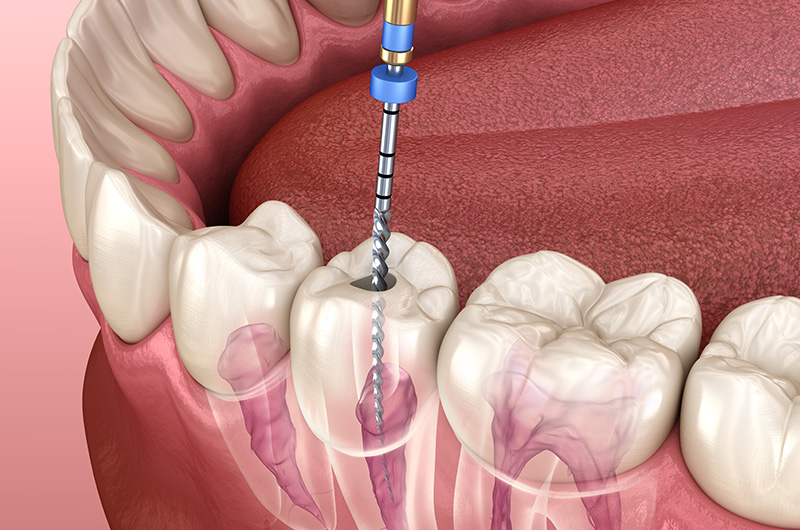 root-canal-2
