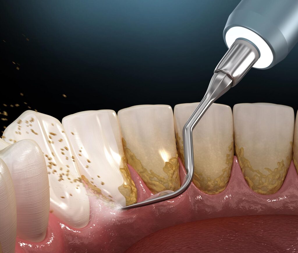 DEEP CLEANING GUMS